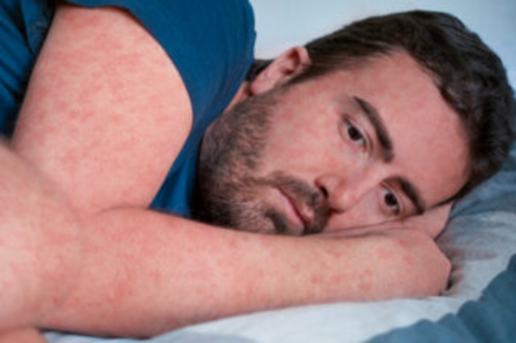 , Link auf Masern - Stadt Köln